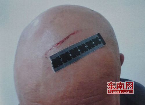 莆田闽运公交司机被打住院 2个多月后遭公司解聘